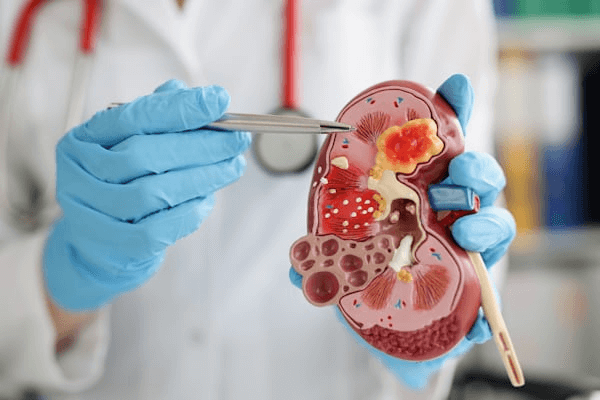 Kidney Stones 101: What Do Kidney Stones Feel Like